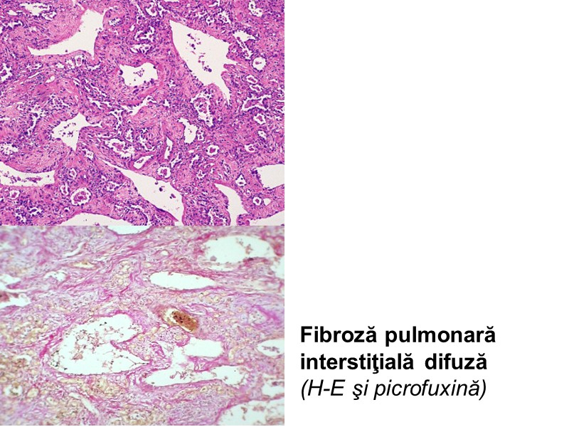 Fibroză pulmonară interstiţială difuză  (H-E şi picrofuxină)